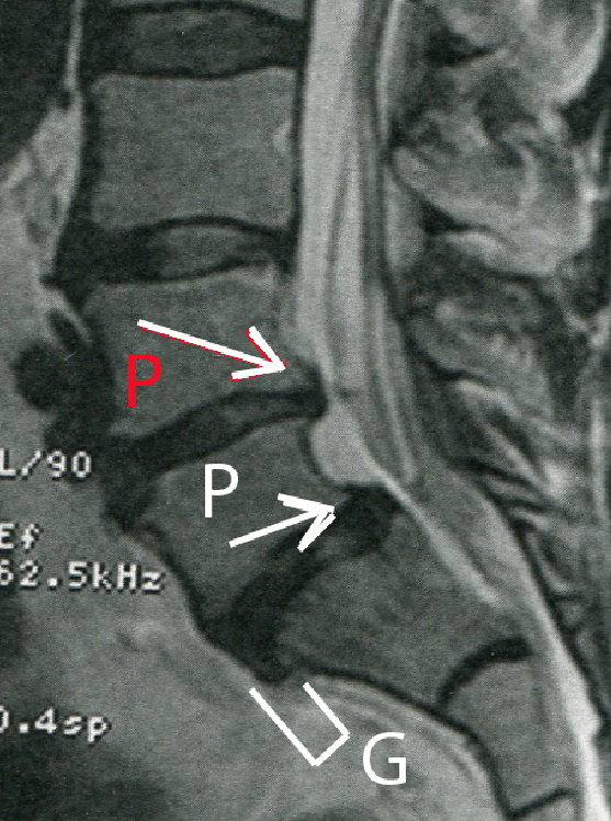 Protrusions