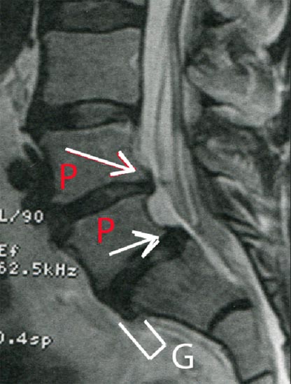 protrusions discales